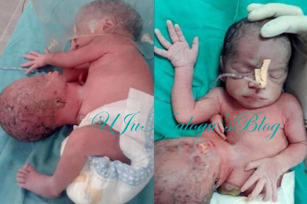 Horror: Baby Born with an Additional Head Attached to its Stomach (Photos)