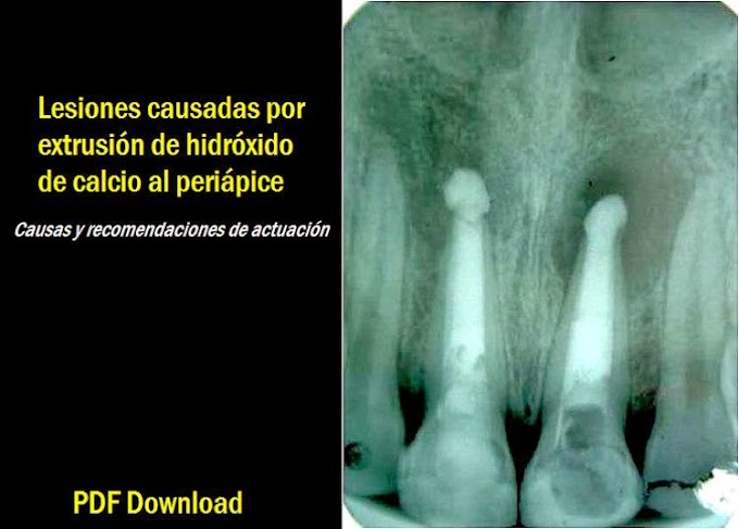 PDF: Lesiones causadas por extrusión de hidróxido de calcio al periápice: Causas y recomendaciones de actuación