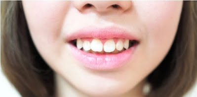 Hô hàm nhẹ có niềng răng được không? Cách nào tốt nhất? 1