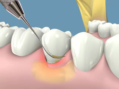 Những điều cần biết về sưng lợi răng khôn