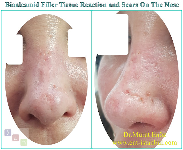 Damages of fillers containing polyalkylimide bioalcamid,Delayed immune response and tissue reaction due to permanent dermal fillers,Damages of permanent nose filler,Risks of permanent nose fillers,