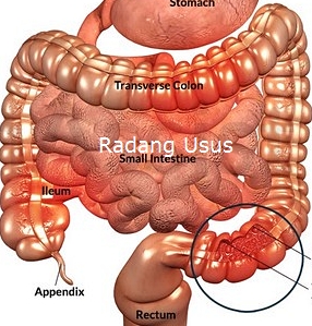 Cara Menyembuhkan Radang Usus Secara Alami
