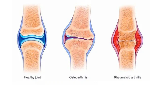 Arthritis Disease: परिभाषा, प्रकार, लक्षण व रोकथाम के उपाय