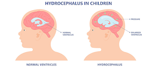 Understanding Pediatric Hydrocephalus and Its Surgical Treatment