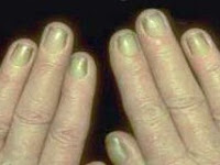 What Does White Lines On Fingernails Mean