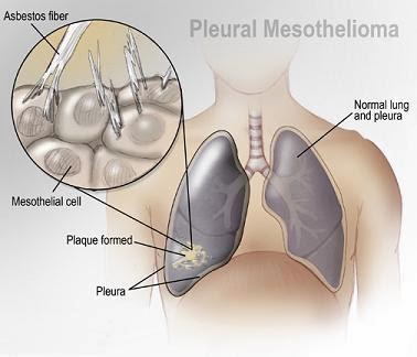 Lungs Cancer, Mesothelioma, Mesothelioma Symptoms,