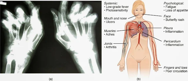 rheumatoid_arthritis_(RA)