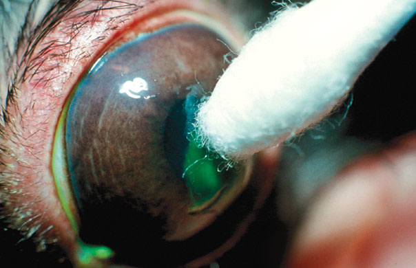 CORNEAL SCRAPING AND CAUTERIZATION OF ULCERS