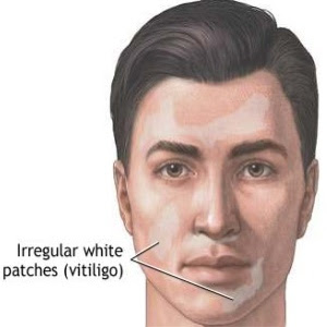 Vitiligo in Face