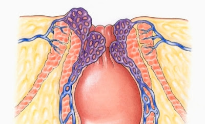 tonjolan didekat anus dibarengi rasa sakit 