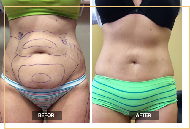 liposuction in Delhi