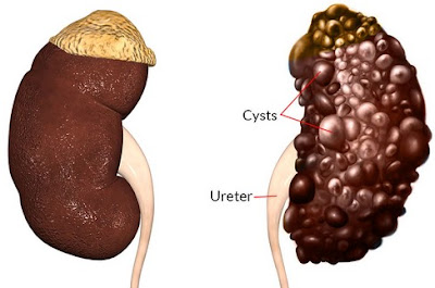 Pengertian Penyakit Kista Ginjal