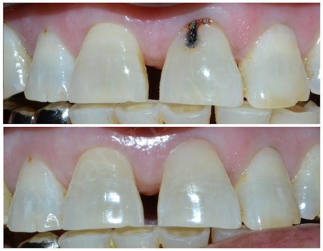Front Tooth Dental Caries treated with Composite filling