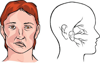 Penyebab Mulut Miring Sebelah / Bells Palsy & Obat Bells Palsy Alami