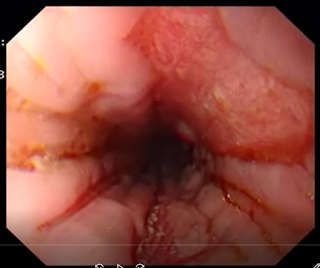 esophageal changes in a patient with gastric outlet obstruction