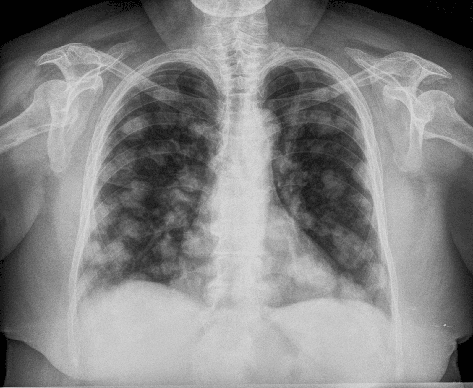 Diagn stico por Im genes Met stasis pulmonares signo 