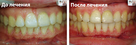 Фото до и после лечения центра зубов