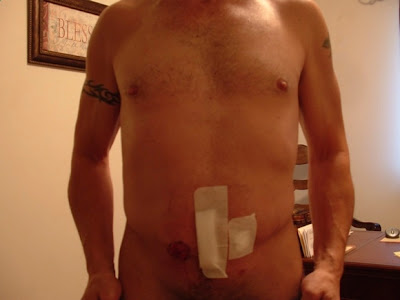 Tips Pengobatan Hernia