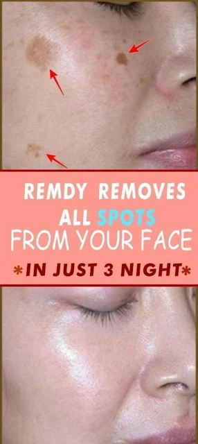 Remove Dark Spots In Just 3 Nights By Doing This Trick