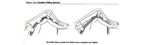 Injury a2 finger anatomy 2