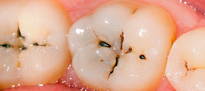 Sâu răng có lây truyền không?