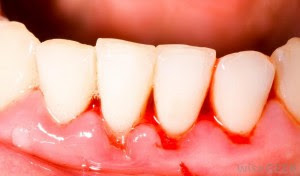 Cách chữa viêm chân răng dân gian lợi bất cập hại 1