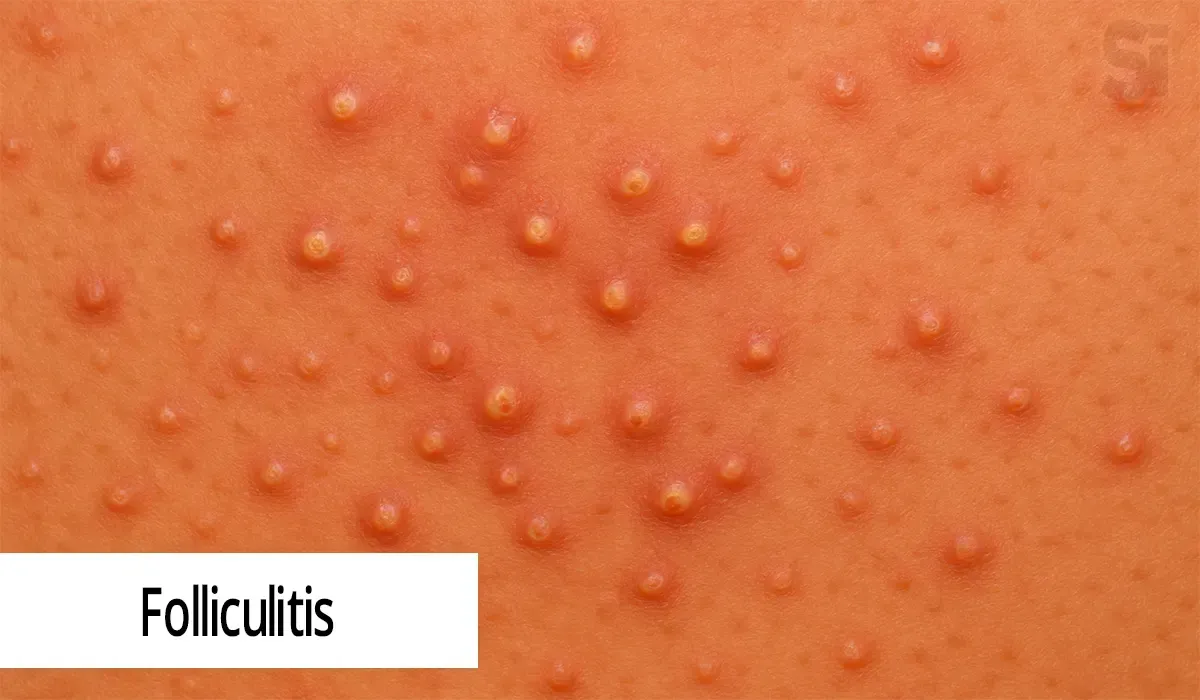 Folliculitis
