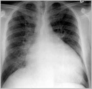 Kalp büyümesi röntgen filmi