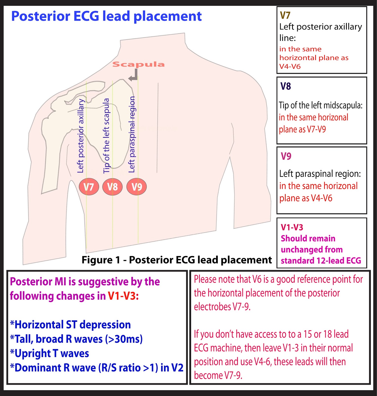ecg educator blog posterior ecg lead placement right sided ekg diagram ecg educator blog