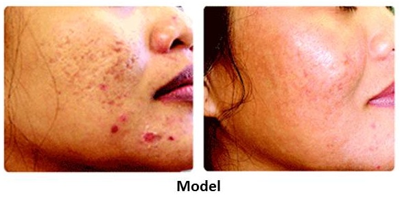 skin resurfacing acne scars acne face masks are excellent natural ...