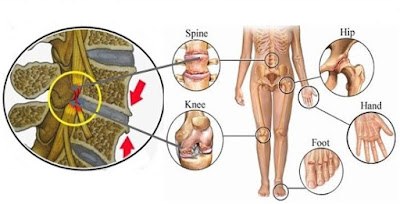 Cara Menghilangkan Sakit Pinggang Akibat Gangguan Syaraf Terjepit