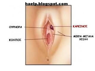 Cancer of the vulva
