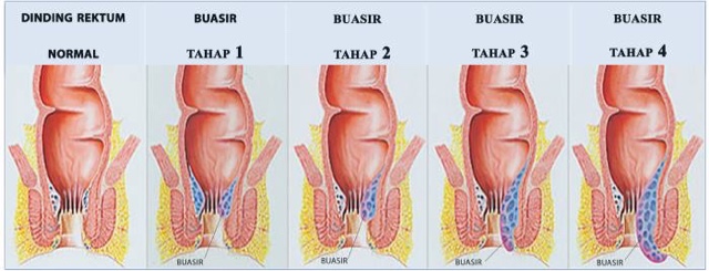 5 Tanda Dan Antara Rawatan Penyakit Buasir - Healthy is a 