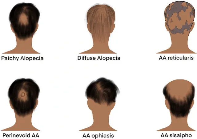 Alopecia Areata