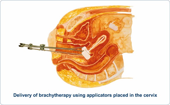 liver cancer recurrence treatment