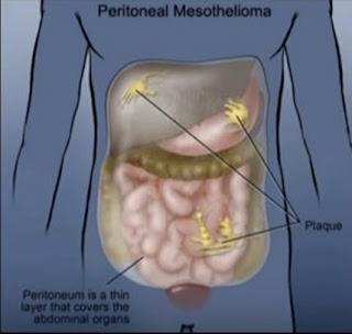 Malignant Mesothelioma