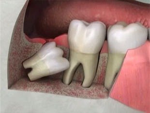 Rút ngắn thời gian đau nhức sau nhổ răng khôn 