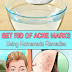 Get Rid of Acne Marks Using Homemade Remedies