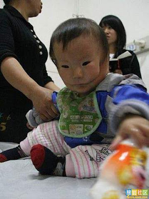 Baby With Double Face in China