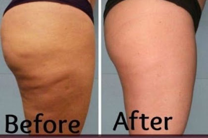 DIY Best Cellulite Scrub That Work Fast In 2 Days! With most Powerful Effective Ingredients