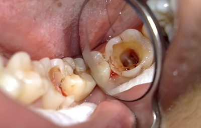 Răng sâu tới tủy cần được điều trị tủy trước tiên