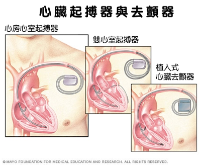 各類型的植入式機器，讓心悸緩解