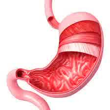 Chronic Pain related to Stomach Cancer