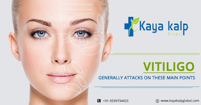 Vitiligo Treatment Specialist Doctor in Delhi