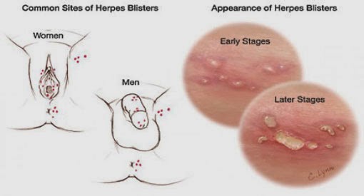 Gejala Penyakit Herpes Genitalis Obat  Sipilis Alami