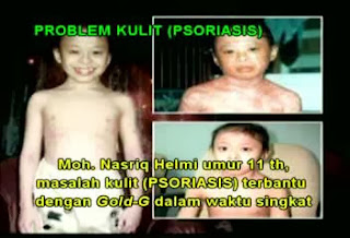 Testimoni Penyakit Psoriasis