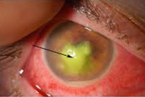 Corneal ulcer