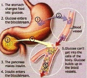 image diabetes type 1 overview and managed