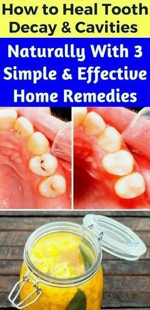 How To Heal Tooth Decay & Cavities Naturally & 3 Simple & Effective Home Remedies