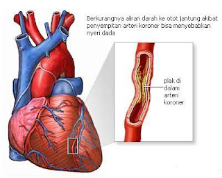 Gejala Penyakit Jantung Koroner